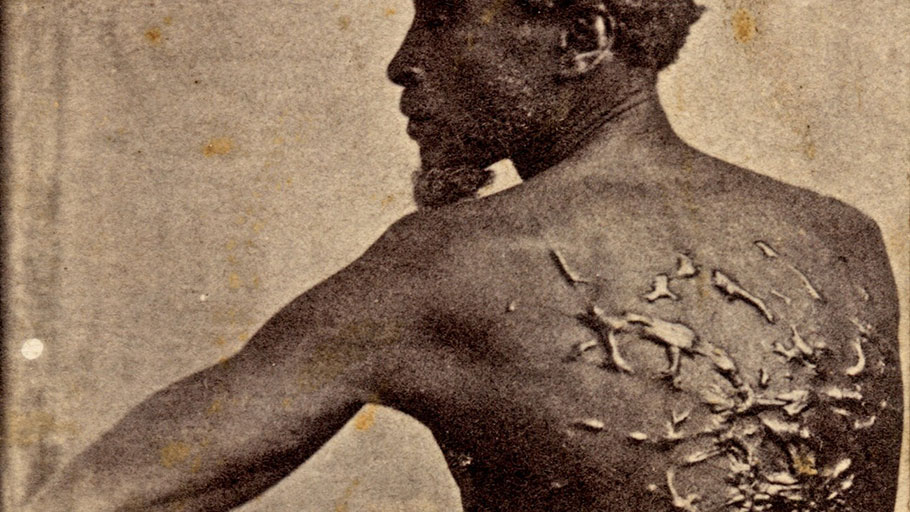 An 1863 photograph that became known as “The Scourged Back”’ shows the whipping scars on Gordon, a former slave in Louisiana who escaped to Union lines.